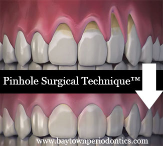 Pinhole Surgical Technique (PST)